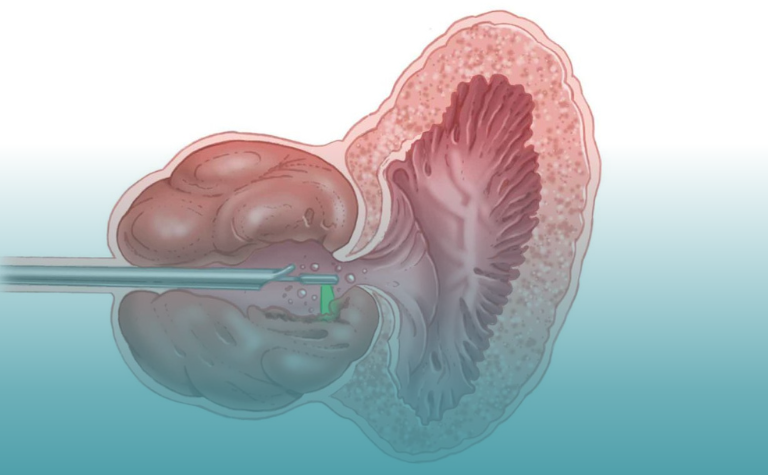 Dr Castellucci - Urologo a Roma tecnica GreenLaser